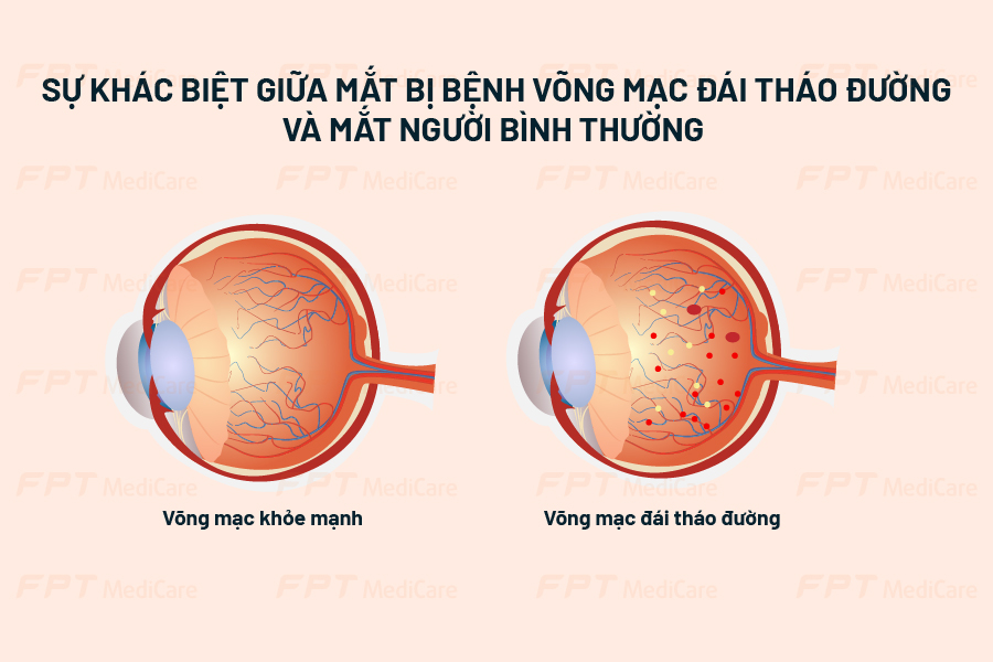 Sự khác biệt giữa mắt bị bệnh võng mạc đái tháo đường và mắt người bình thường