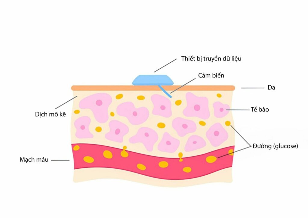 Hình minh hoạ cấu trúc dưới da và vị trí của cảm biến CGM   