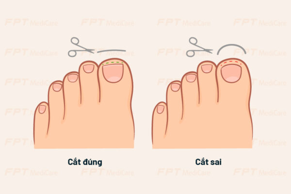 Cắt móng chân đúng cách