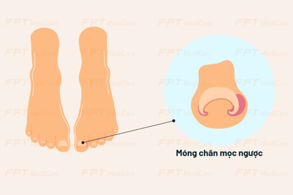 móng chân mọc ngược trong tiểu đường