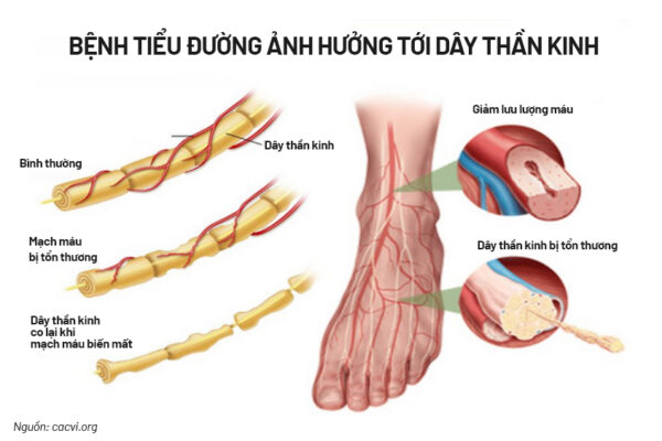 bệnh thần kinh tiểu đường ở chân