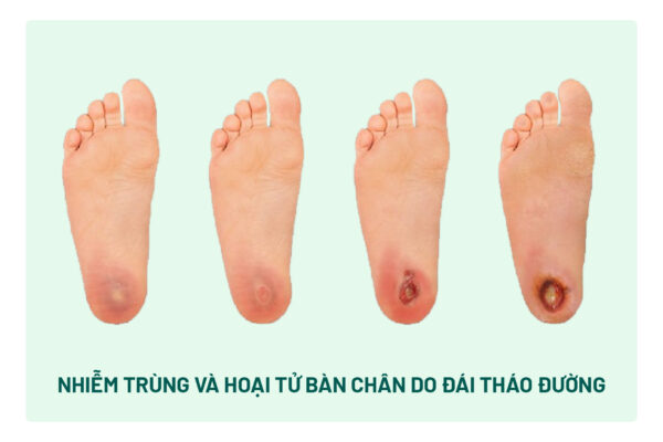 Nhiễm trùng và hoại tử bàn chân do đái tháo đường